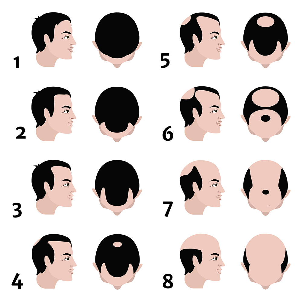 What Is A Receding Hairline Stages Causes Prevention What Is A Receding Hairline Stages Causes Prevention