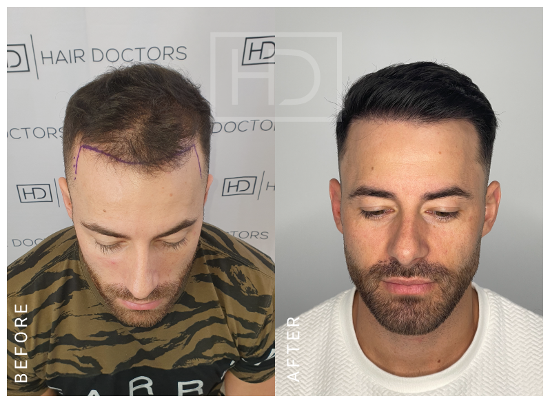 hair transplant before after