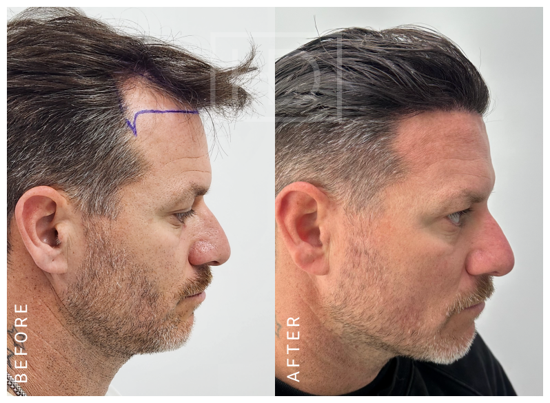 hair transplant before after