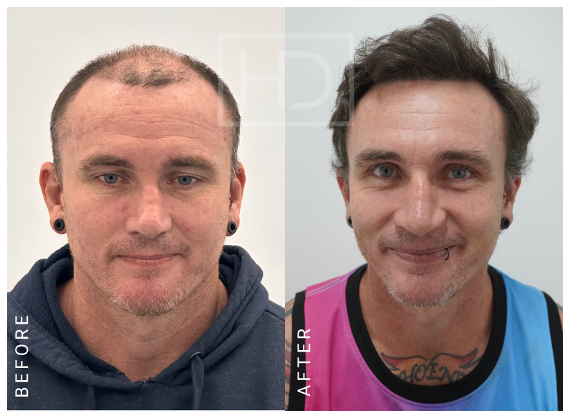 hair transplant before after