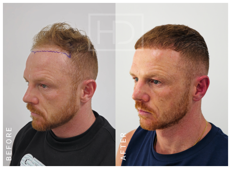 hair transplant before after