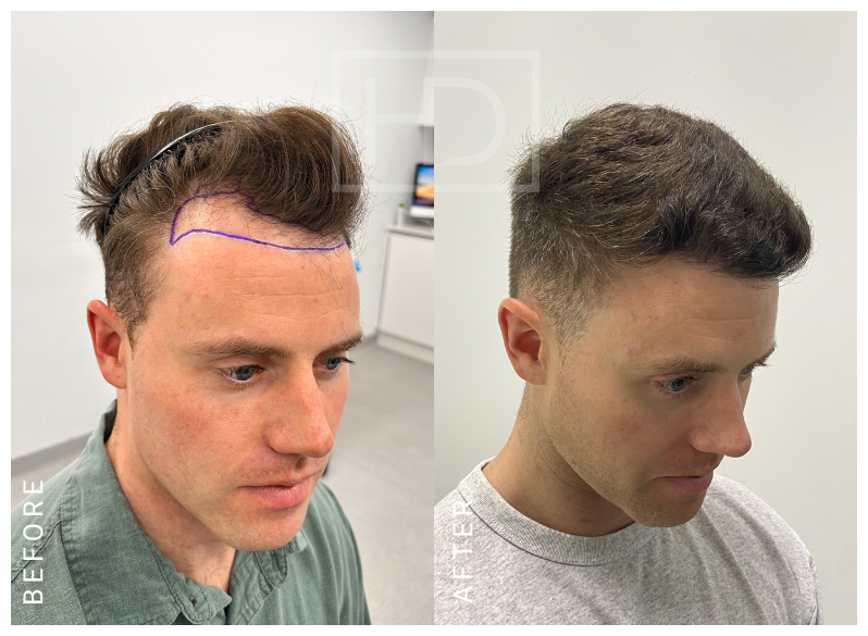 hair transplant before after