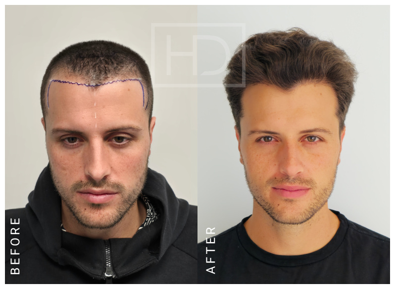 hair transplant before after