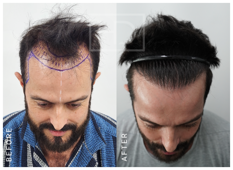 hair transplant before after