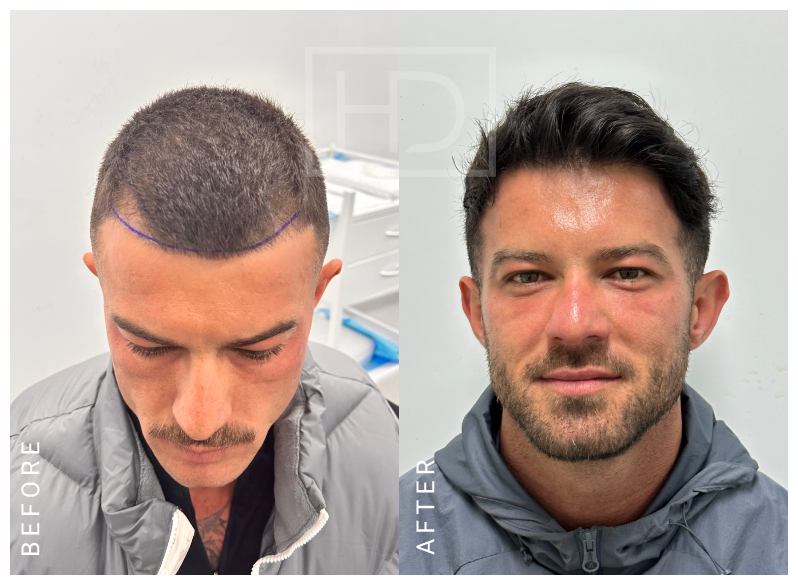 hair transplant before after