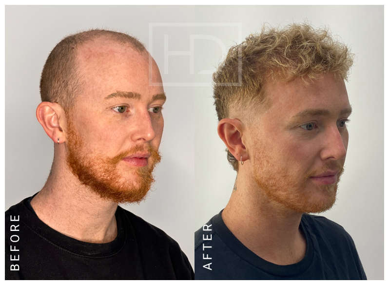 hair transplant before after