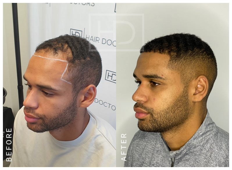 hair transplant before after