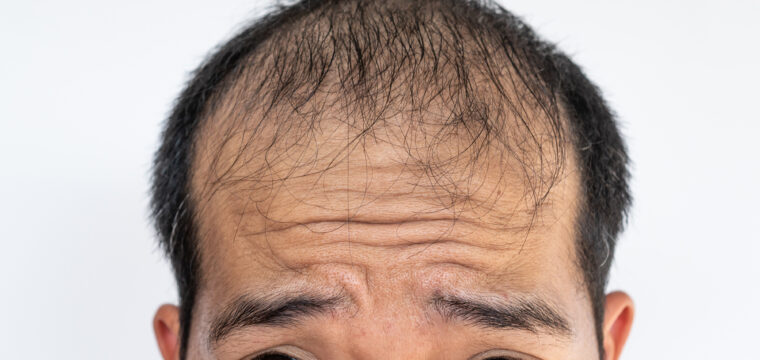 Finasteride for Hair Loss | Effectiveness | Side Effects | Male Pattern Baldness | Hair Restoration Clinics | Hair Doctors Sydney, Melbourne, Parramatta