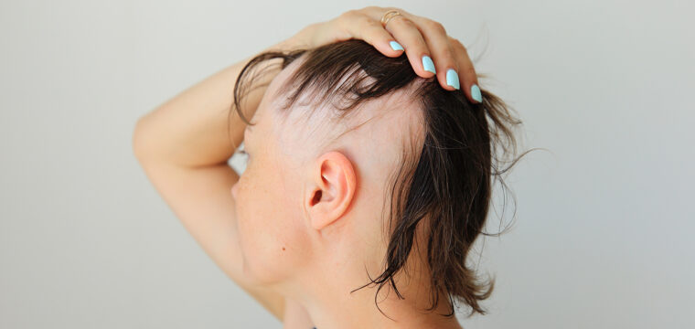 What Causes Alopecia | Genetic | Autoimmune | Stress | Nutrition | Hair Loss Clinic | Hair Regrowth Treatments | Hair Doctors Sydney & Melbourne