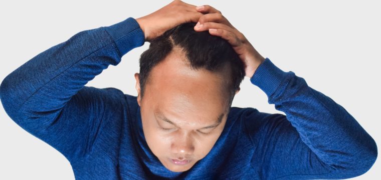 Best Shampoos for Hair Loss in Australia