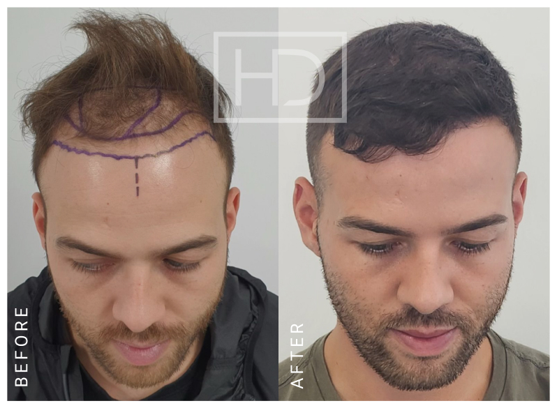 What Happens To Donor Area After Hair Transplant | Hair Loss Clinic Melbourne, Sydney, Parramatta | Hair Doctors