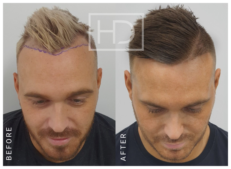 Importance Of Graft Survival In Hair Restoration | Hair Transplant Recovery | Clinic Melbourne, Sydney, Parramatta | Hair Doctors