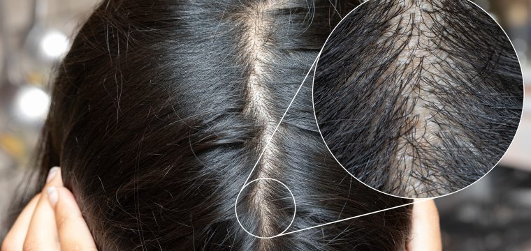Scalp Conditions That Can Cause Hair Loss | Psoriasis, Dermatitis, Infections | Oily, Dry, Flaking Scalp | Medical Hair Treatments | Hair Doctors Sydney