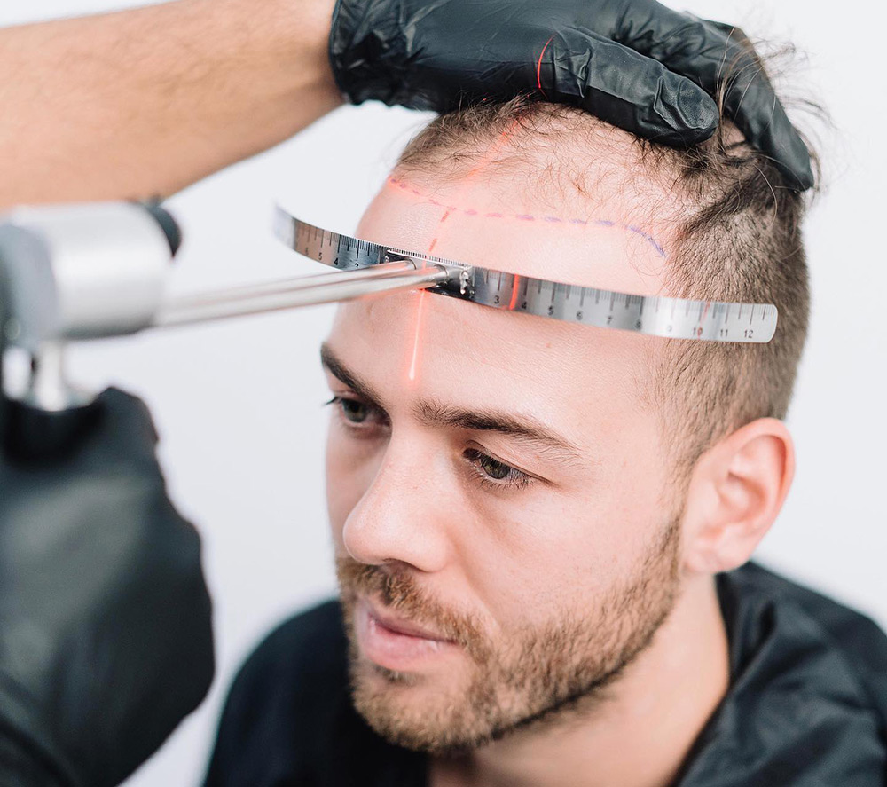 Creatine & Hair Loss | Causes Of Balding | Hair & Scalp Assessment | Hair Restoration Clinic | Hair Doctors Sydney & Melbourne